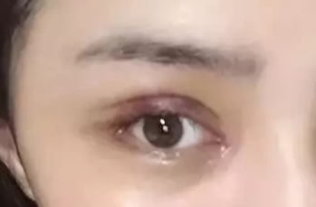 韓式開眼角失敗了怎么辦？