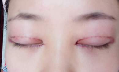 韓式開眼角手術(shù)有哪些優(yōu)勢(shì)？開眼角手術(shù)有哪些優(yōu)勢(shì)？