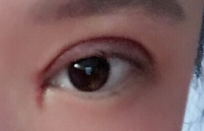 韓式開眼角手術有哪些優(yōu)勢？