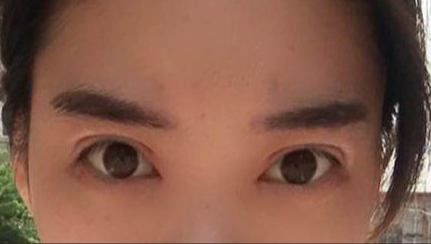 韓式開(kāi)眼角的有副作用嗎？