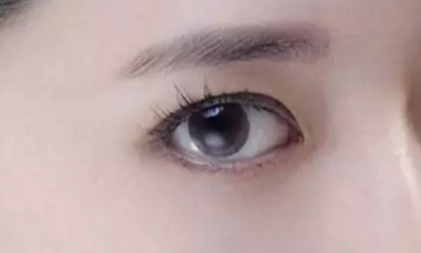 韓式開眼角的手術(shù)費(fèi)用是多少？