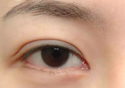 開內(nèi)外眼角多久能恢復(fù)好？開內(nèi)外眼角多少錢？