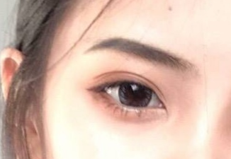 開內(nèi)外眼角的恢復期是多久？術(shù)后后遺癥有哪些？