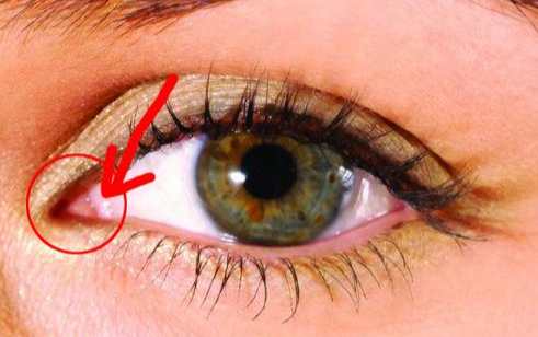 開(kāi)內(nèi)眼角手術(shù)有什么效果？
