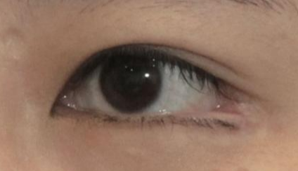 開內(nèi)眼角都會回縮嗎？