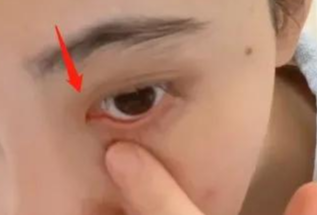 開(kāi)內(nèi)眼角對(duì)眼睛有傷害嗎？