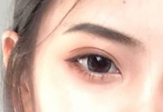 開內(nèi)外眼角有什么壞處？