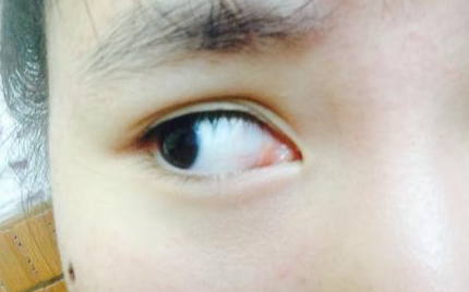 開內(nèi)眼角風(fēng)險(xiǎn)有多大？