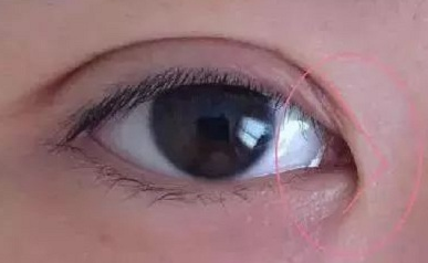 開內(nèi)眼角的作用有哪些？開內(nèi)眼角都會(huì)回縮嗎？
