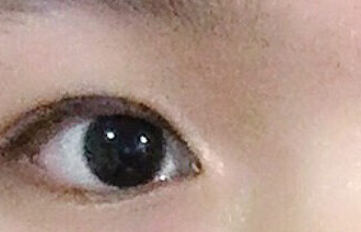 開(kāi)內(nèi)眼角的危害有哪些？