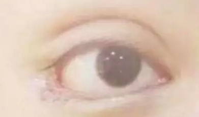 開內(nèi)眼角的效果好嗎？
