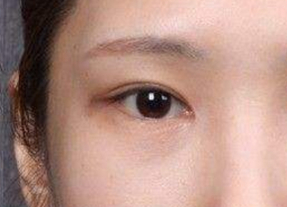 開(kāi)內(nèi)外眼角腫幾天？