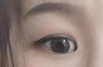 開(kāi)內(nèi)眼角的手術(shù)費(fèi)用多少？