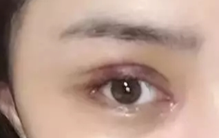 開眼角一般要恢復(fù)多久？開眼角一定會(huì)出現(xiàn)疤痕嗎？