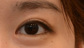 開眼角有效果嗎？開眼角有哪些危害？