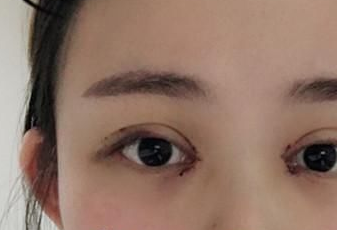 開眼角后多長時間能恢復？