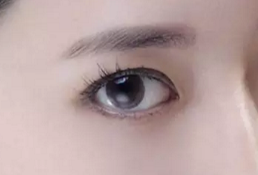 開眼角術(shù)后多久才能恢復？開眼角術(shù)后防止疤痕增生怎么做？