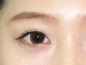 開眼角手術(shù)有哪些適應(yīng)人群呢？開眼角手術(shù)有哪些特點(diǎn)？