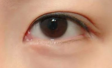 做完開眼角手術(shù)有什么優(yōu)勢？