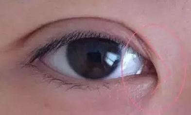 開(kāi)眼角手術(shù)價(jià)格要多少錢(qián)？