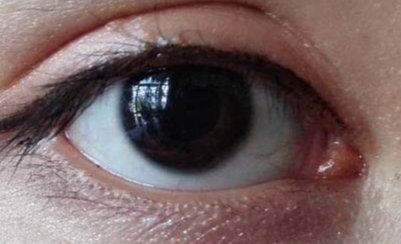 做完開眼角疼不疼？