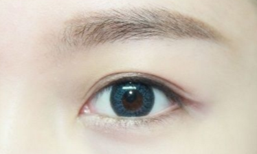 開眼角需要注意的事項有哪些？