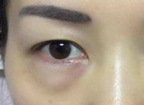 光纖溶脂去眼袋術(shù)后如何護(hù)理？