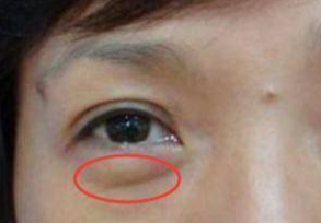 埋線去眼袋能維持多久？
