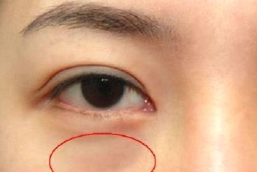 光纖溶脂祛眼袋需要多少錢？光纖溶脂怎么樣呢？