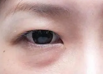 激光祛眼袋有用嗎？
