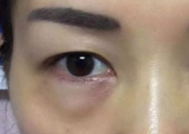 激光可以祛眼袋嗎？激光祛眼袋有哪些副作用？