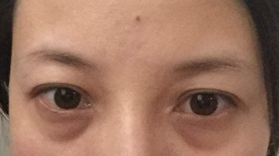 激光祛除眼袋有效嗎？激光祛眼袋有什么利弊？