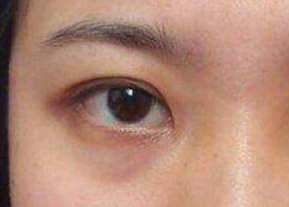 去眼袋是激光好還是內(nèi)切好？激光祛眼袋是什么原理？