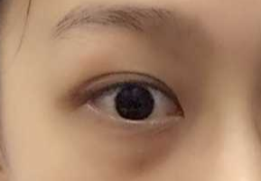 激光祛眼袋要多少錢？