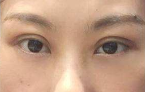 激光祛除眼袋的手術(shù)效果好嗎？
