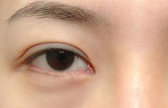 激光去眼袋多久做一次？