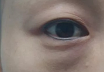 激光去眼袋可以管多久？
