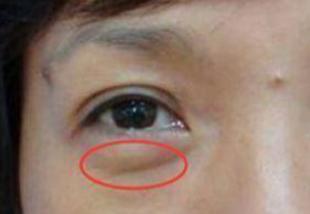 激光去眼袋可以管多久？激光祛眼袋多久可以恢復(fù)？