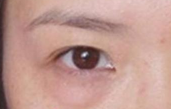 激光去除眼袋后遺癥有哪些？