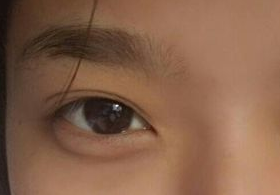 激光去眼袋后需多久能恢復(fù)？激光去眼袋快速有效嗎？