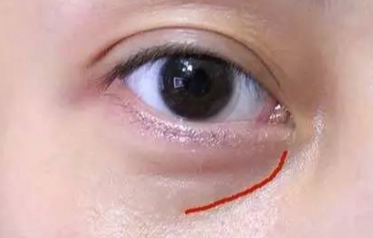 激光去眼袋手術(shù)費(fèi)用是多少？