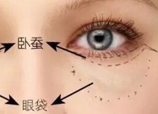 激光去眼袋多久才能恢復(fù)？激光去眼袋有什么副作用嗎？