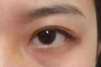 激光祛眼袋效果真的好嗎？激光去眼袋會(huì)有風(fēng)險(xiǎn)嗎？
