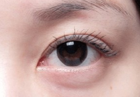 激光去眼袋會(huì)不會(huì)很疼？激光去眼袋什么人適合？