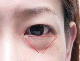 激光除眼袋效果如何？激光去眼袋要注意什么？