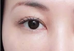 激光去眼袋什么人適合？