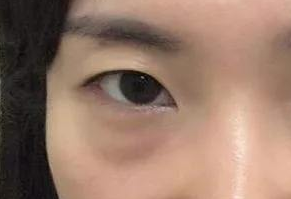 激光祛眼袋會(huì)疼嗎？激光去眼袋手術(shù)好嗎？