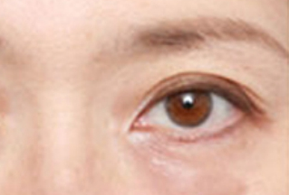 激光去眼袋幾天能恢復(fù)？激光去眼袋是怎樣的？