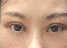 激光去眼袋可保持多久？激光去除眼袋效果好不好？