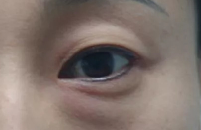 激光去除眼袋效果好不好？